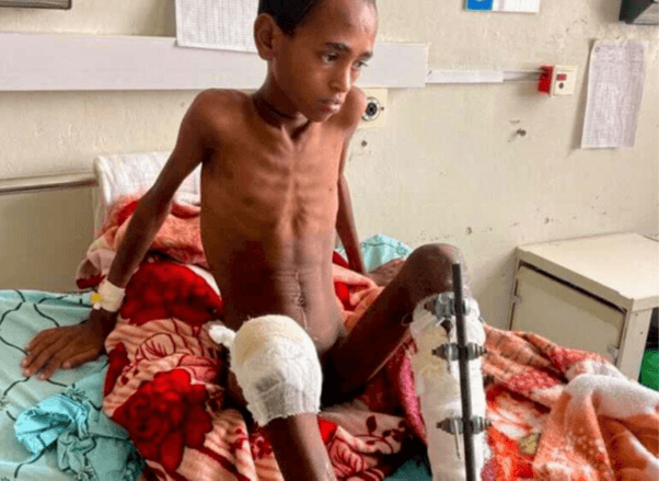 Tigray: child at the hospital in Mekele